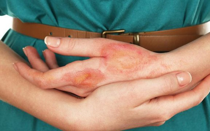 diabetes complication at skin