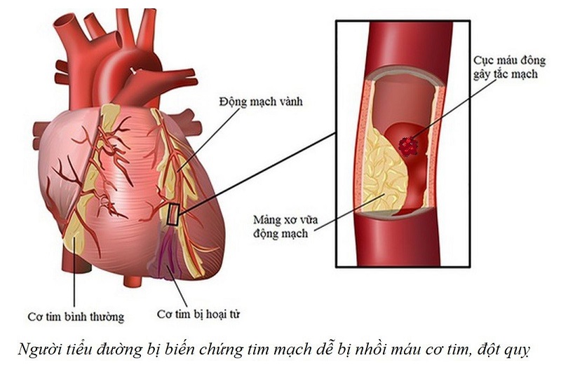 bien chung benh tieu duong 5