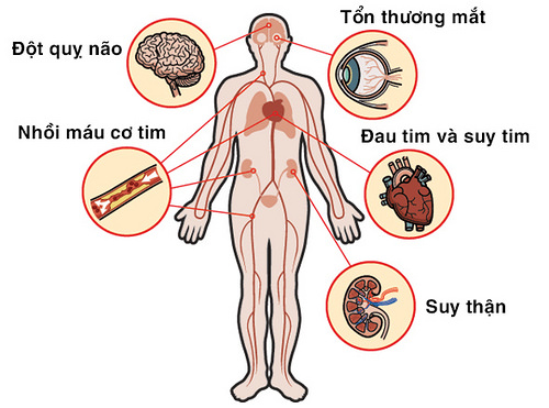 dau hieu trieu chung cua cao huyet ap 3