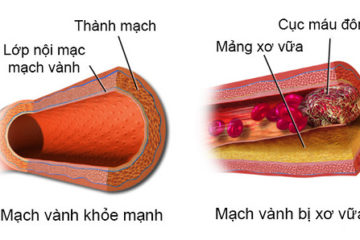 mang xo vua 360x240