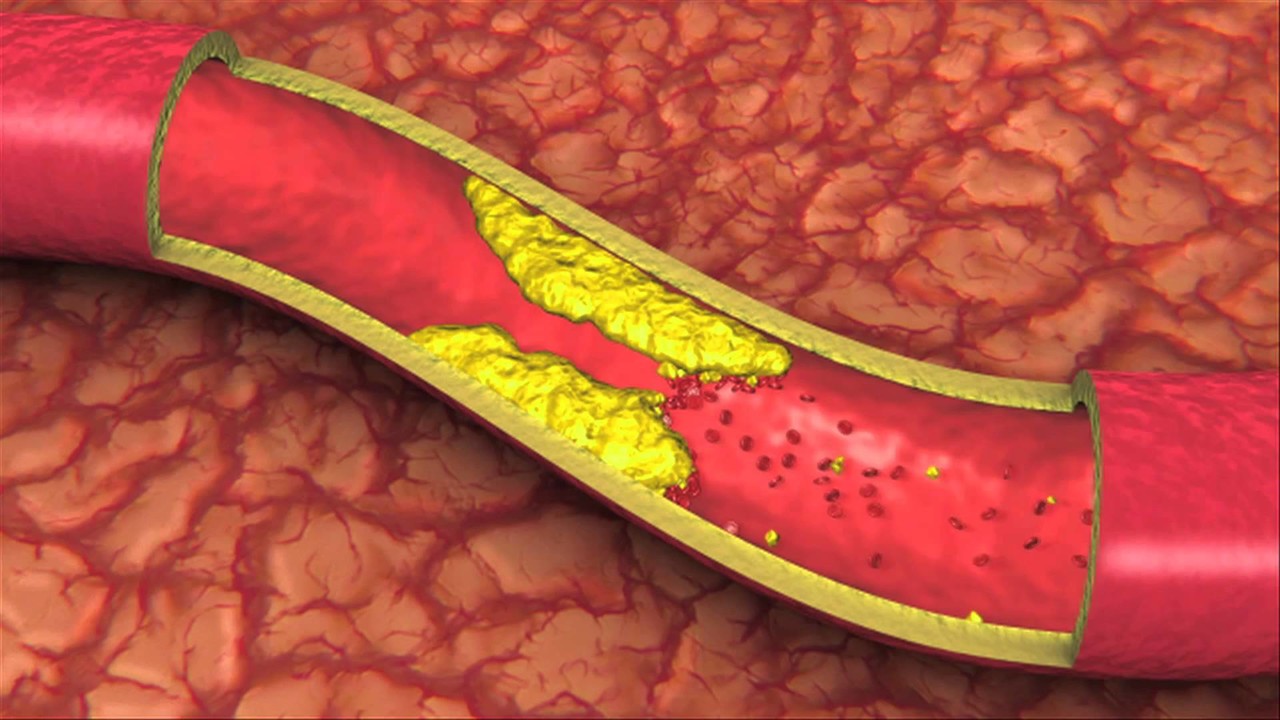 roi loan lipid mau co nguy co mac benh tieu duong